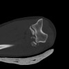 SPORK, NICO - 22.03.1976 - 02.08.2022 - CT obere Extremität - 18:02:23